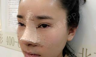 北京玻尿酸隆鼻价格 玻尿酸隆鼻手术价格